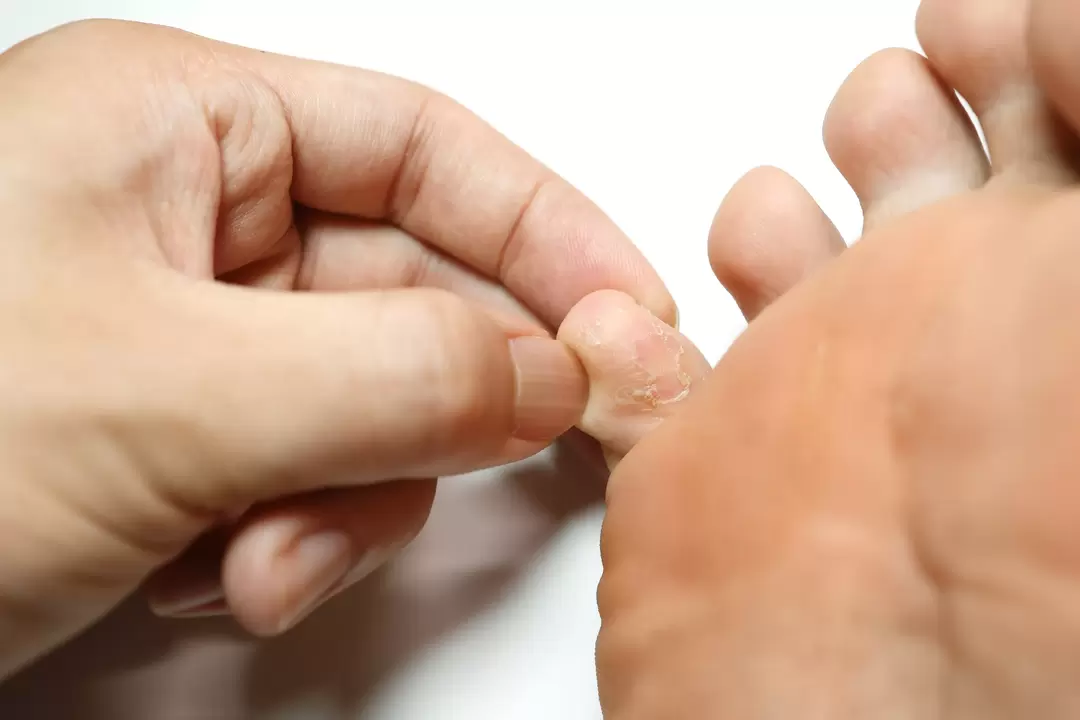 Houba na prstech a její ošetření zxcvbnmqwert krémem s krémem