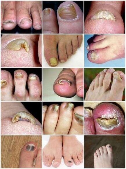 Plísňová infekce nehtové ploténky