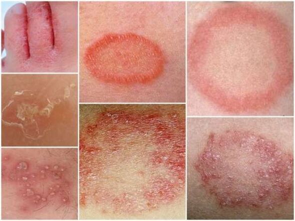 Trichofytóza kůže nohou