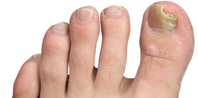 plísňová infekce nehtové ploténky